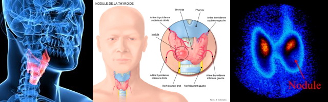 nodule de la thyroide
