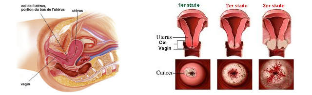 cancer du col de l'uterus